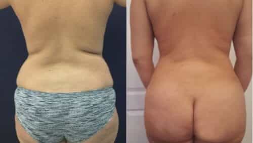 tummy tuck colombia 288-6-min