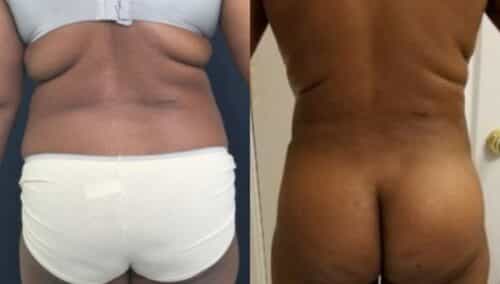 tummy tuck colombia 289-1-min