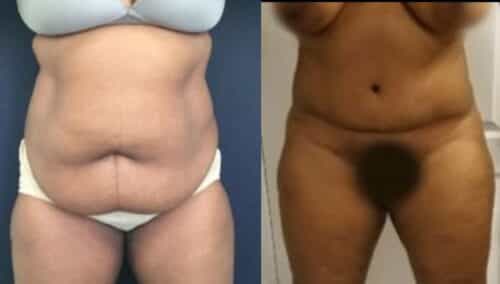 tummy tuck colombia 289-12-min