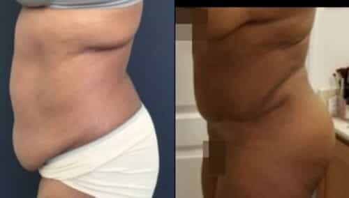 tummy tuck colombia 289-3-min