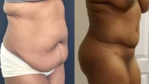 tummy tuck colombia 289-31-min