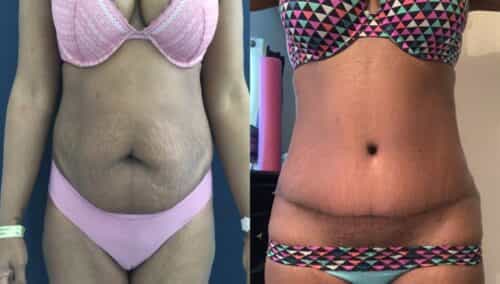 tummy tuck colombia 290-1-min