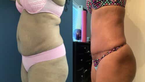 tummy tuck colombia 290-2-min