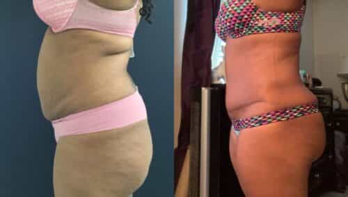 tummy tuck colombia 290-3-min