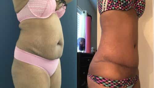 tummy tuck colombia 290-4-min