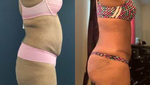 tummy tuck colombia 290-5-min