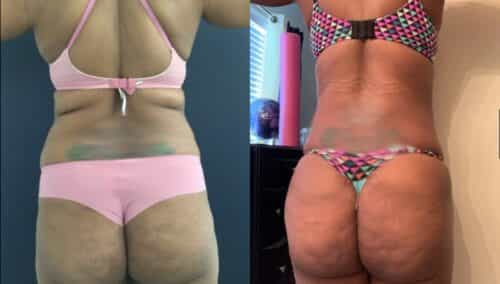 tummy tuck colombia 290-6-min