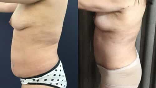 tummy tuck colombia 293-2-min