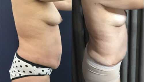 tummy tuck colombia 293-3-min