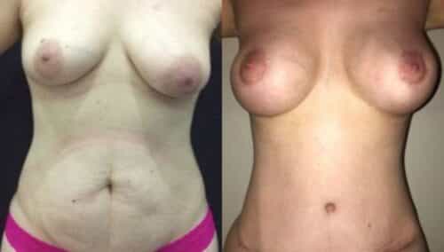 tummy tuck colombia 297-1-min
