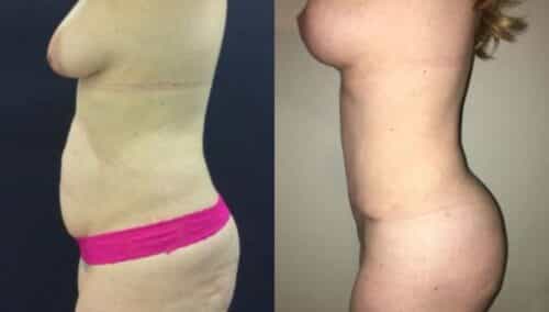 tummy tuck colombia 297-2-min