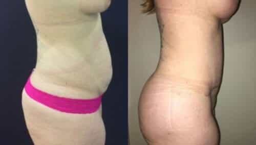 tummy tuck colombia 297-3 (1)-min