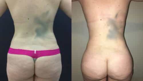 tummy tuck colombia 297-4-min