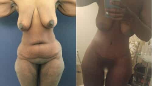 tummy tuck colombia 298-1-min