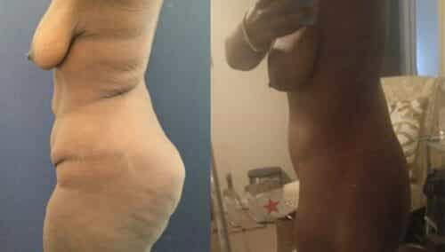 tummy tuck colombia 298-2-min