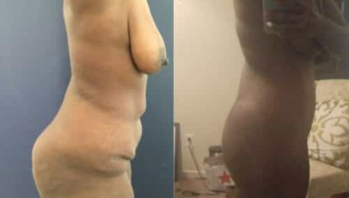 tummy tuck colombia 298-3-min