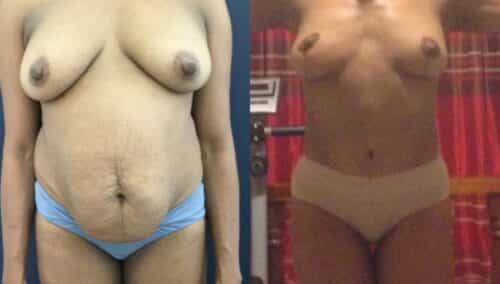tummy tuck colombia 299-1-min