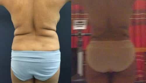 tummy tuck colombia 299-2-min