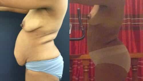 tummy tuck colombia 299-31-min