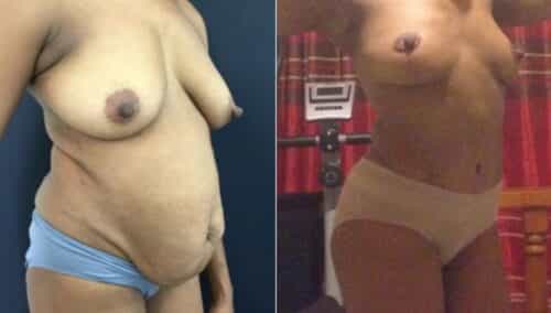 tummy tuck colombia 299-4-min
