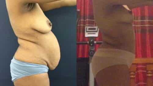 tummy tuck colombia 299-5-min