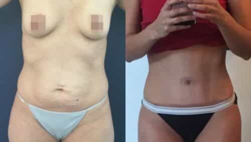tummy tuck colombia 300-1-min