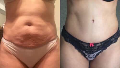 tummy tuck colombia 301-1-min