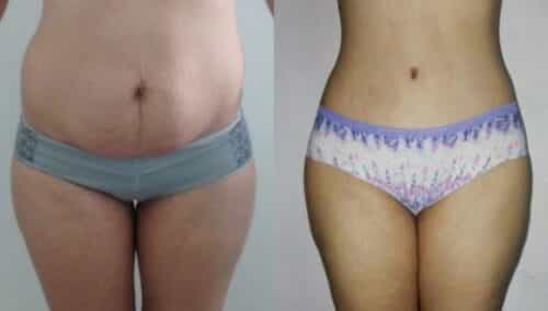 tummy tuck colombia 302-1-min