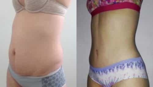 tummy tuck colombia 302-2-min