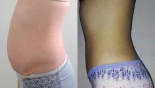 tummy tuck colombia 302-3-min