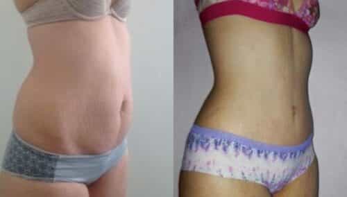 tummy tuck colombia 302-4-min