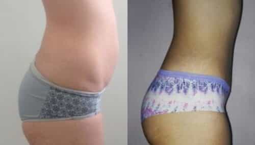 tummy tuck colombia 302-5-min