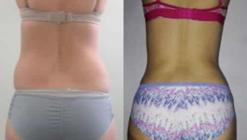 tummy tuck colombia 302-6-min