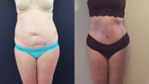 tummy tuck colombia 303-1-min