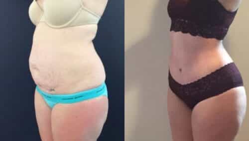 tummy tuck colombia 303-2-min