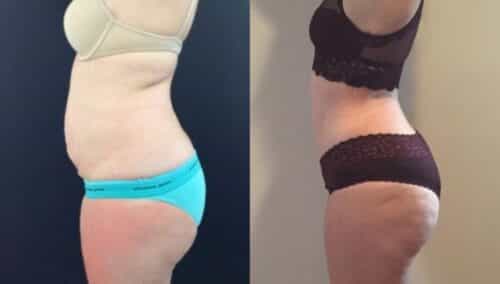 tummy tuck colombia 303-3-min