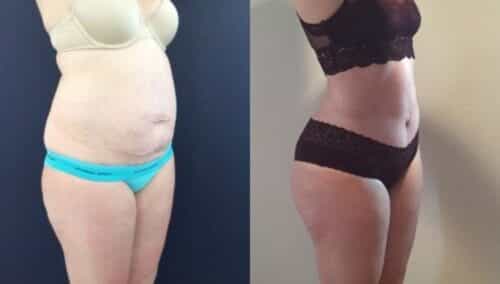 tummy tuck colombia 303-4-min