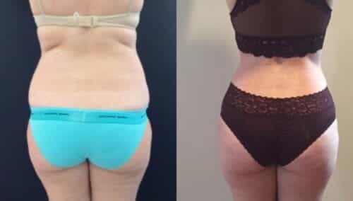tummy tuck colombia 303-5-min