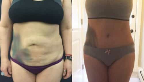 tummy tuck colombia 310-1-min