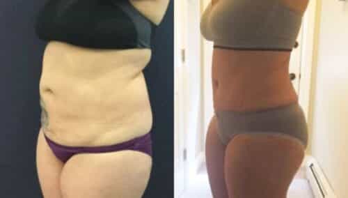 tummy tuck colombia 310-2-min