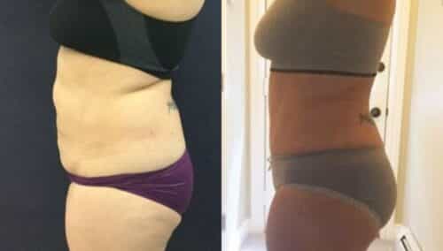 tummy tuck colombia 310-3-min