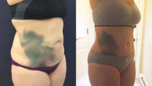tummy tuck colombia 310-4-min