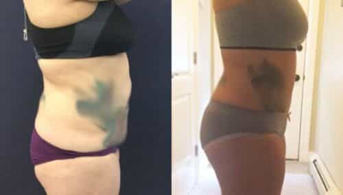 tummy tuck colombia 310-5-min