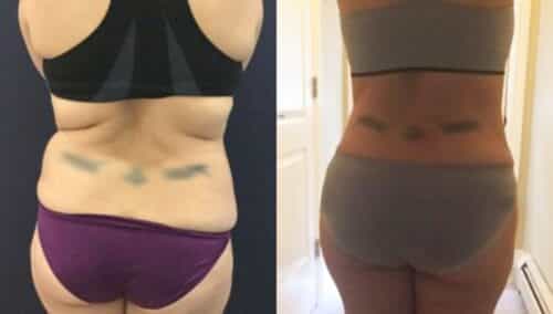 tummy tuck colombia 310-6-min