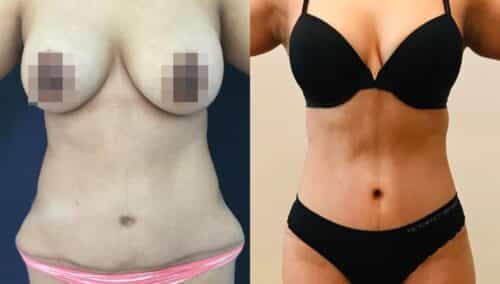 tummy tuck colombia 318-1-min