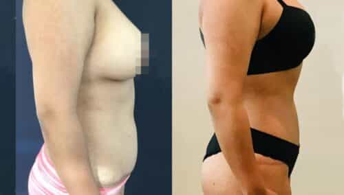 tummy tuck colombia 318-2-min