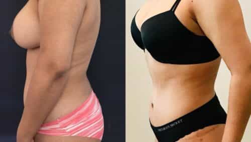 tummy tuck colombia 318-3-min