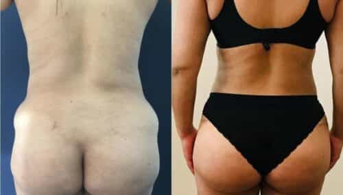 tummy tuck colombia 318-4-min