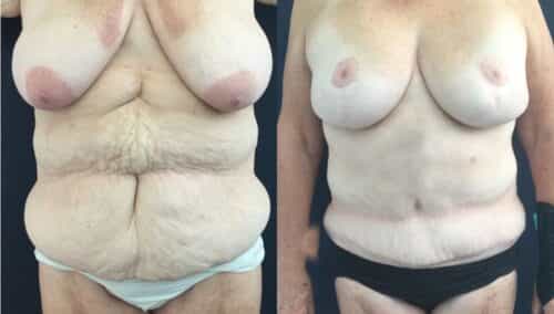 tummy tuck colombia 322-1-min