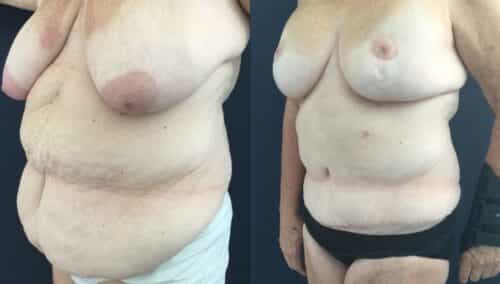 tummy tuck colombia 322-2-min